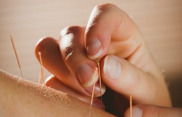 Acupuncture