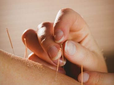 Acupuncture